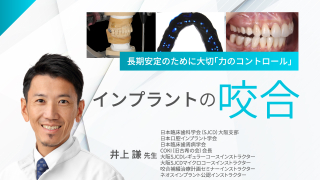 サイナスフロアエレベーション アルティメットガイド 全てを満たす究極