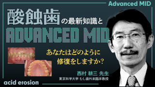 酸蝕⻭の最新知識とAdvanced MIDの画像です。