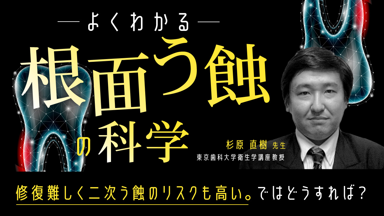 エビデンスに基づいた根面う蝕の予防的アプローチ〜疫学、診断基準、リスクファクター、予防〜の画像です。