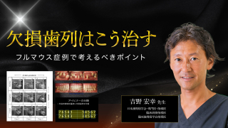 欠損歯列はこう治す〜フルマウス症例で考えるべきポイント〜の画像です。