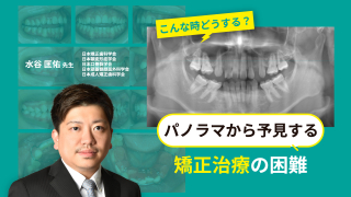 こんな時どうする？パノラマから予見する矯正治療の困難の画像です。