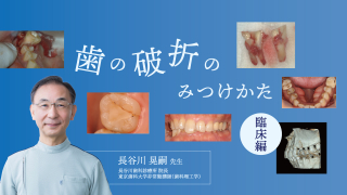 【臨床編】歯の破折のみつけかたの画像です。
