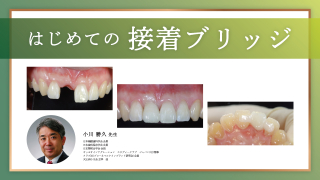 はじめての接着ブリッジの画像です。