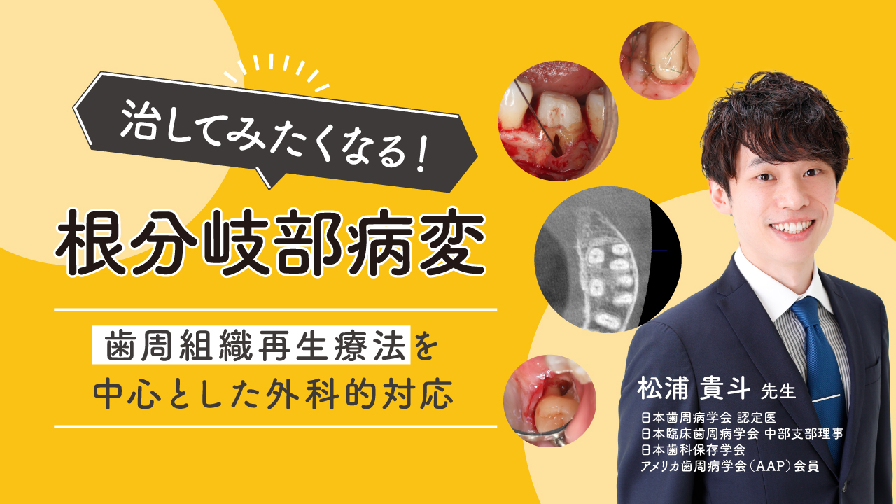 治してみたくなる！根分岐部病変〜歯周組織再生療法を中心とした外科的
