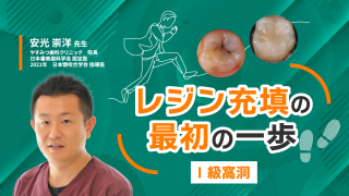 レジン充填の最初の一歩〜Ⅰ級窩洞〜の画像です。