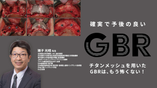確実で予後の良いGBR〜チタンメッシュを用いたGBRは、もう怖くない！〜の画像です。