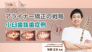 アライナー矯正の戦略 小臼歯抜歯症例の画像です。
