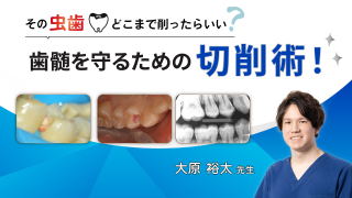 その虫歯どこまで削ったらいい？歯髄を守るための切削術！の画像です。