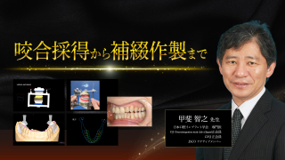 咬合採得から補綴作製までの画像です。