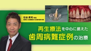 再生療法を中心に据えた歯周病難症例の治療の画像です。
