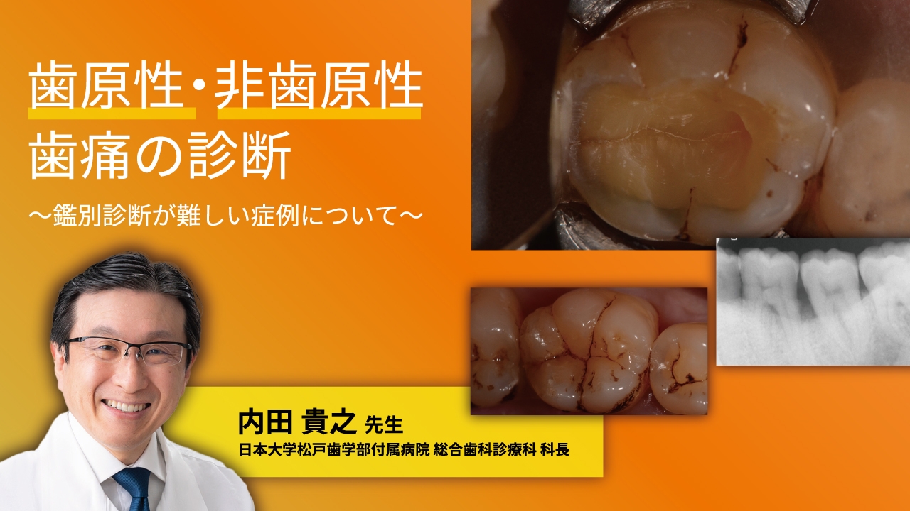 歯原性・非歯原性歯痛の診断～鑑別診断が難しい症例について～ | WHITE