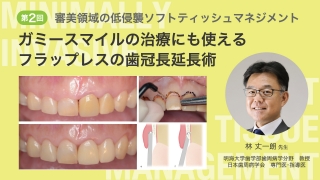 第2回 ガミースマイルの治療にも使えるフラップレスの歯冠長延長術の画像です。