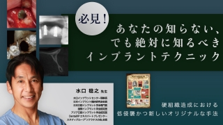 必見！あなたの知らない、でも絶対に知るべきインプラントテクニックの画像です。