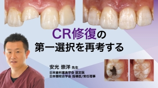 CR修復の第一選択を再考するの画像です。