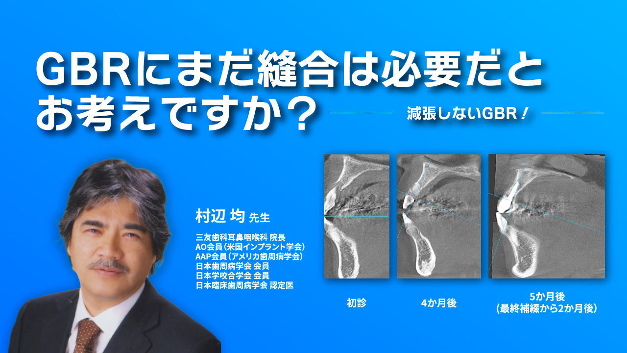 GBRにまだ縫合は必要だとお考えですか？減張しないGBR！の画像です。