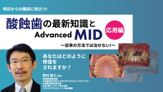 【応用編】明日からの臨床に役立つ！酸蝕⻭の最新知識とAdvanced MID〜従来の方法では治せない！〜の画像です。