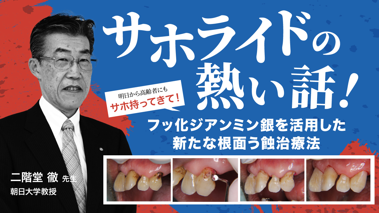 SDF法 : フッ化ジアンミン銀を活用した根面う蝕マネジメント サホライドの熱い話！〜フッ化ジアンミン銀を活用した新たな根面う蝕
