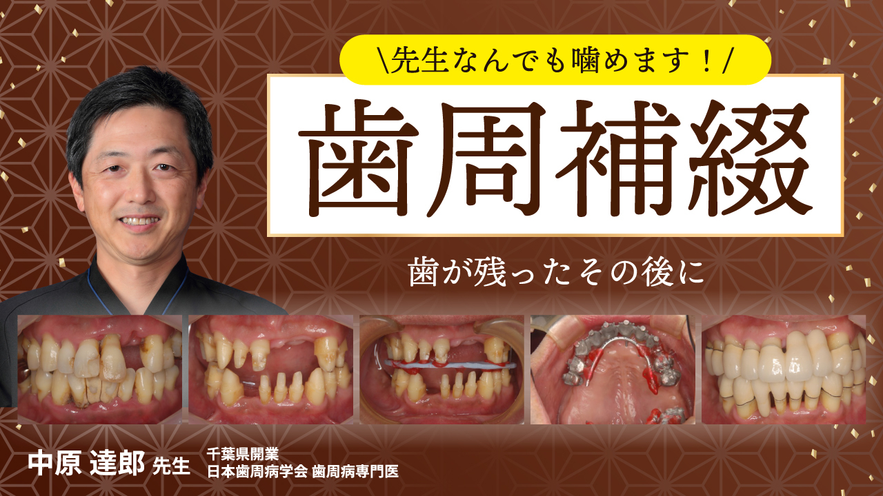 歯周補綴~歯が残ったその後に~の画像です。