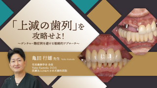 「上減の歯列」を攻略せよ！〜デンチャー難症例を避ける戦略的アプローチ〜の画像です。