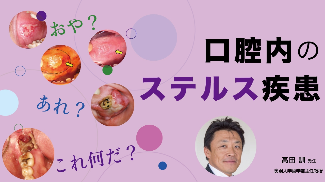 おや？あれ？これ何だ？口腔内のステルス疾患 | WHITE CROSS