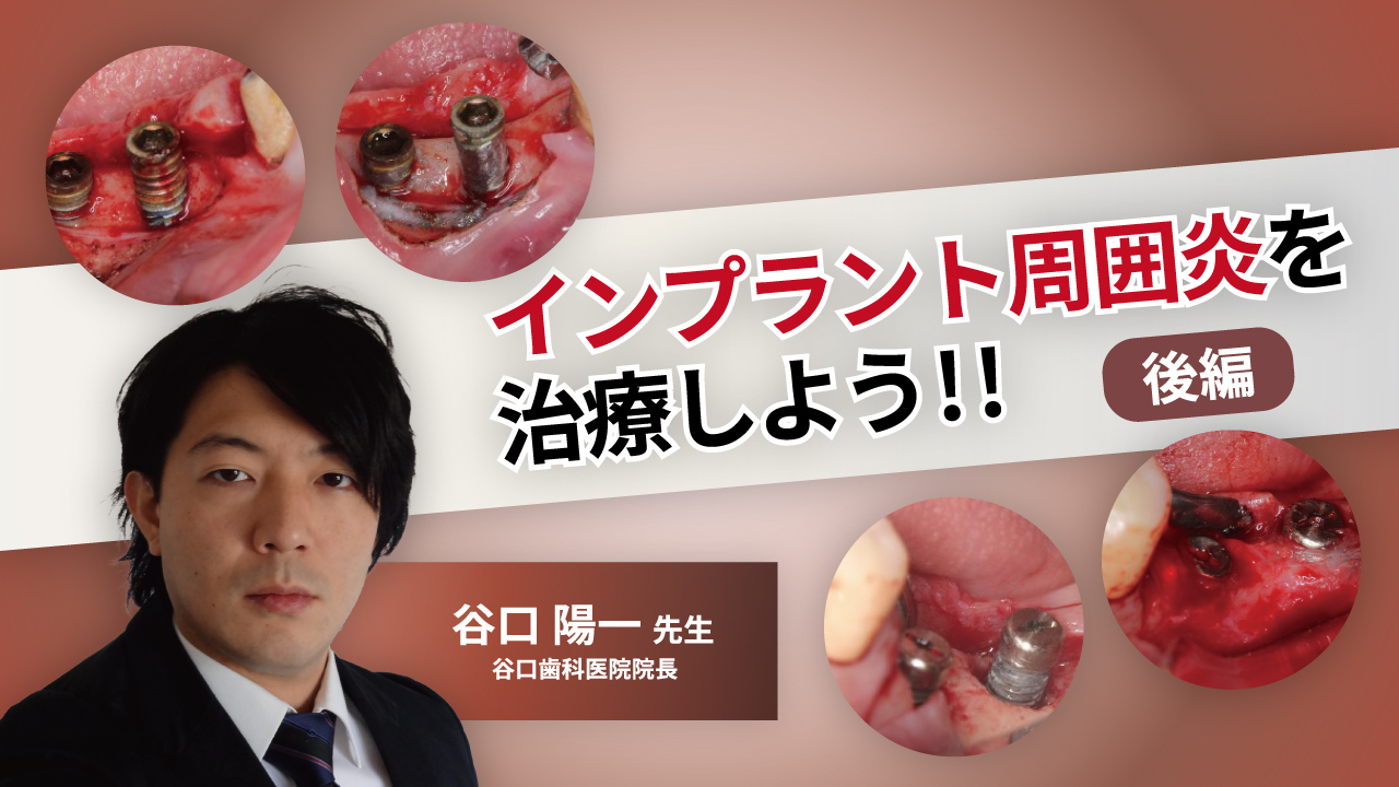 インプラント周囲炎を治療しよう!!後編の画像です。