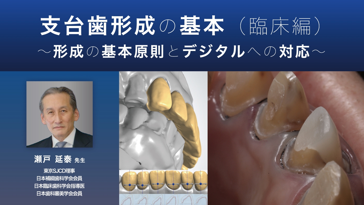 支台歯形成のかんどころ : うまい形成下手な形成 支台歯形成のかんどころ うまい形成下手な形成