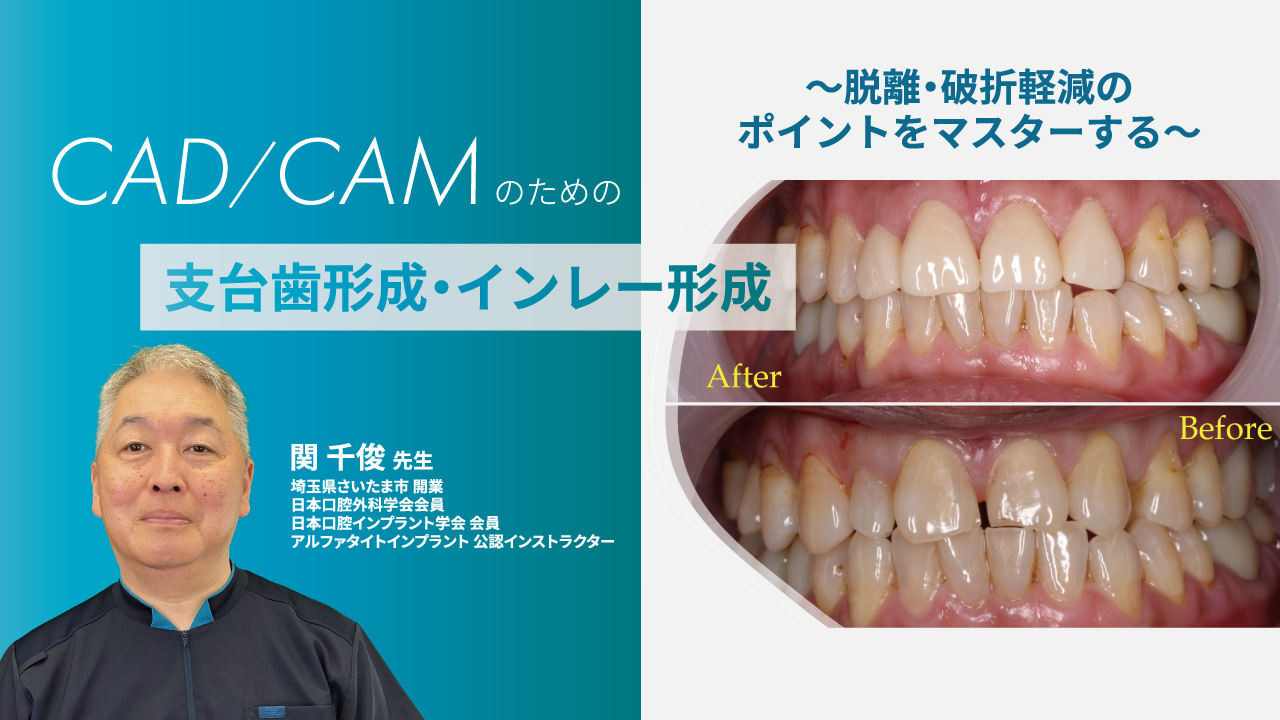 CAD/CAMのための支台歯形成・インレー形成〜脱離・破折軽減のポイント