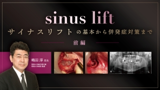 サイナスフロアエレベーション アルティメットガイド 全てを満たす究極