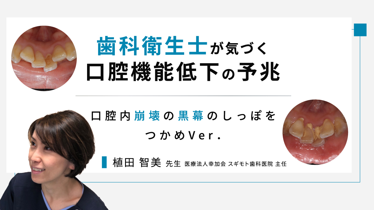 歯科衛生士が気づく口腔機能低下の予兆～口腔内崩壊の黒幕のしっぽをつかめVer.～の画像です。