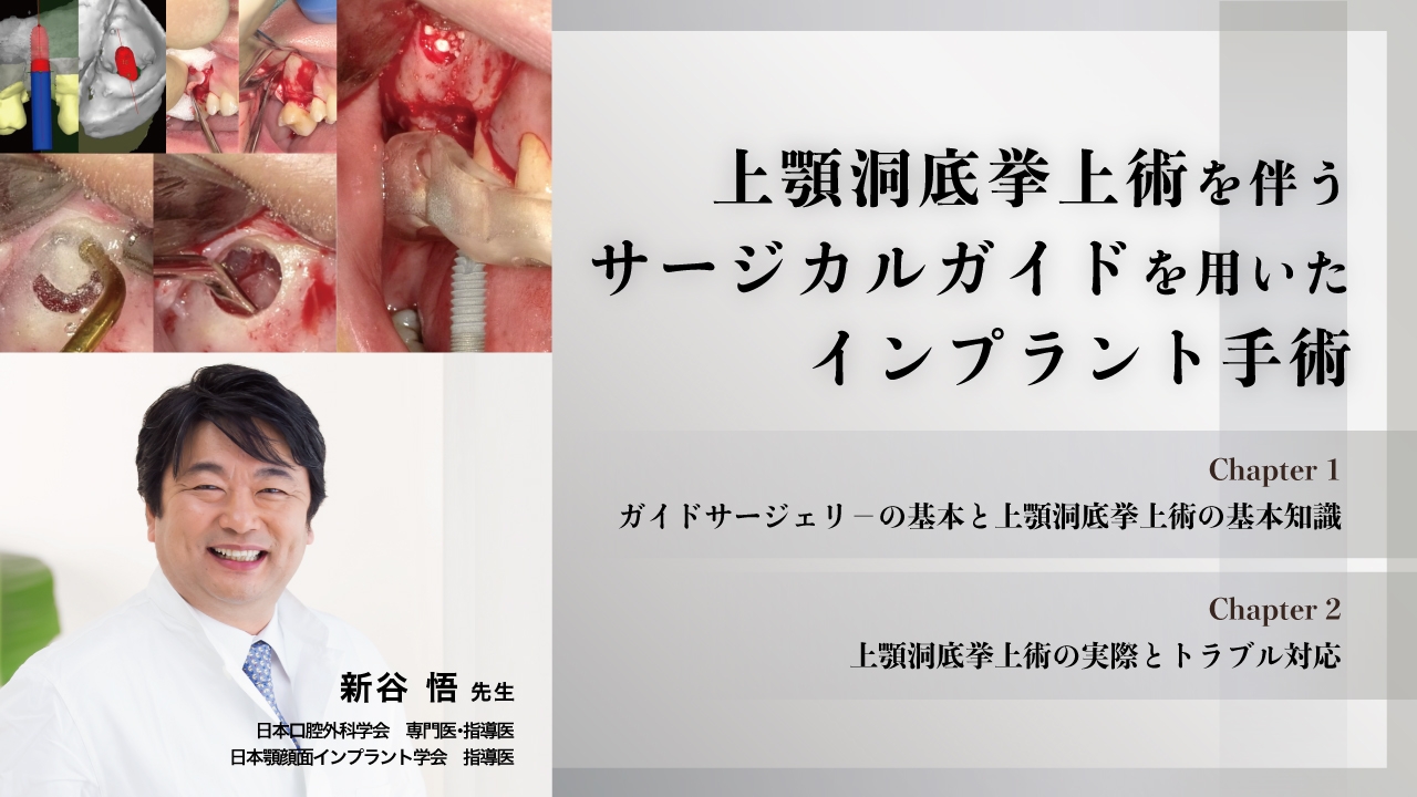 上顎洞底挙上術を伴うサージカルガイドを用いたインプラント手術 
