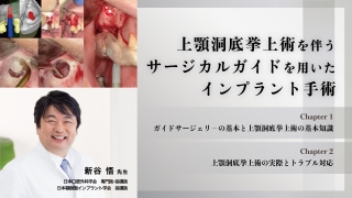 上顎洞底挙上術を伴うサージカルガイドを用いたインプラント手術の画像です。