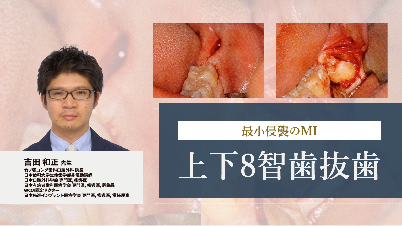 最小侵襲のMI 上下8智歯抜歯の画像です。