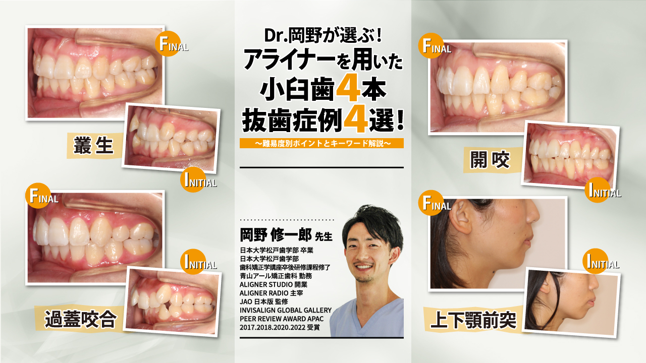 Dr.岡野が選ぶ！アライナーを用いた小臼歯4本抜歯症例4選！～難易度別