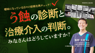 う蝕の診断と治療介入の判断。みなさんはどうしていますか？の画像です。