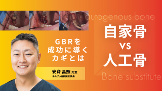 サイナスフロアエレベーション アルティメットガイド 全てを満たす究極