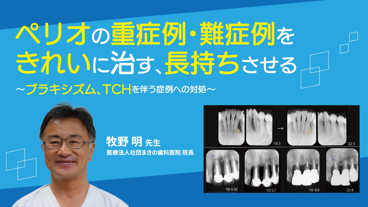 ペリオの重症例・難症例をきれいに治す、長持ちさせる〜ブラキシズム、TCHを伴う症例への対処〜の画像です。
