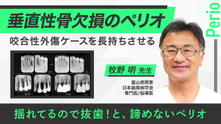 垂直性骨欠損のペリオ 咬合性外傷ケースを長持ちさせるの画像です。