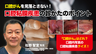 口腔がんを見落とさない！口腔粘膜疾患の診かたのポイントの画像です。