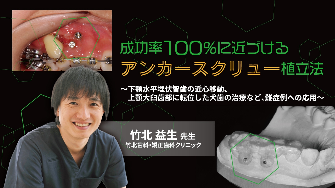 成功率100％に近づけるアンカースクリュー植立法〜下顎水平埋伏智歯の