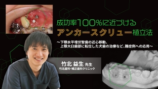 成功率100％に近づけるアンカースクリュー植立法〜下顎水平埋伏智歯の近心移動、上顎大臼歯部に転位した犬歯の治療など、難症例への応用〜の画像です。