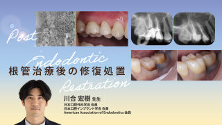 Post Endodontic Restration 根管治療後の修復処置の画像です。