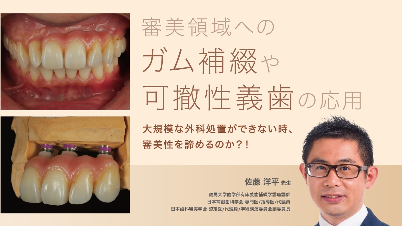 審美領域へのガム補綴や可撤性義歯の応用 −大規模な外科処置ができない時、審美性を諦めるのか?!−の画像です。