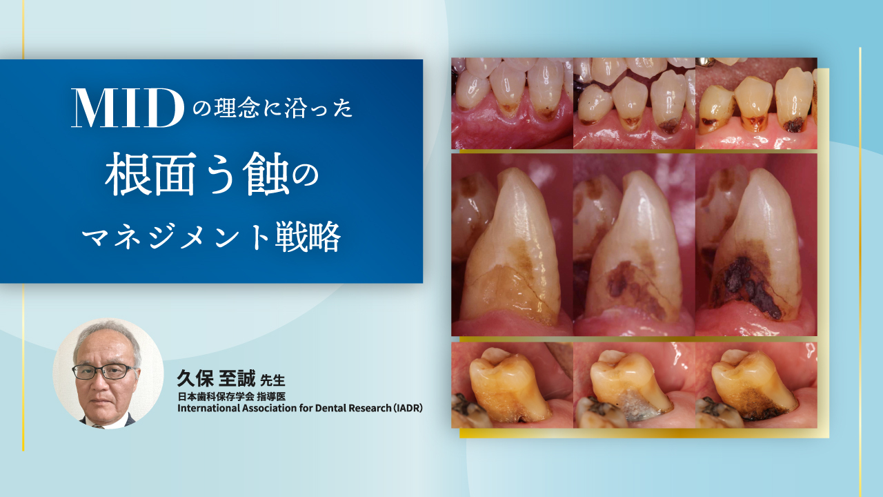 MIDの理念に沿った根面う蝕のマネジメント戦略の画像です。