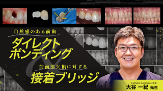 自然感のある前歯ダイレクトボンディングと、前歯部欠損に対する接着ブリッジの勘所の画像です。
