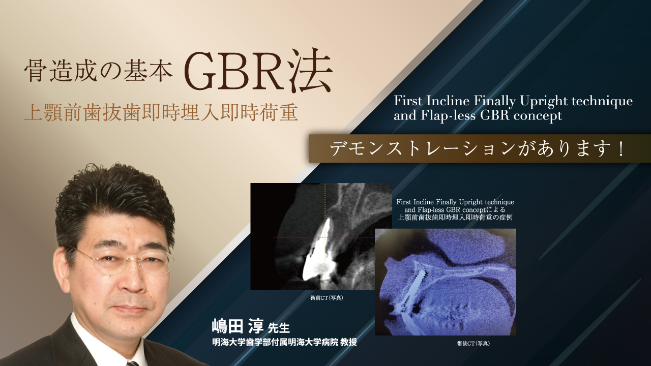 骨造成の基本 GBR法 上顎前歯抜歯即時埋入即時荷重（First Incline
