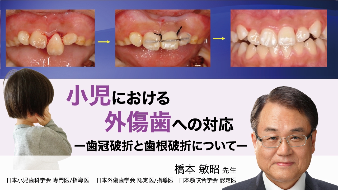 小児における外傷歯への対応 ー歯冠破折と歯根破折についてーの画像です。