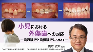 小児における外傷歯への対応 ー歯冠破折と歯根破折についてーの画像です。