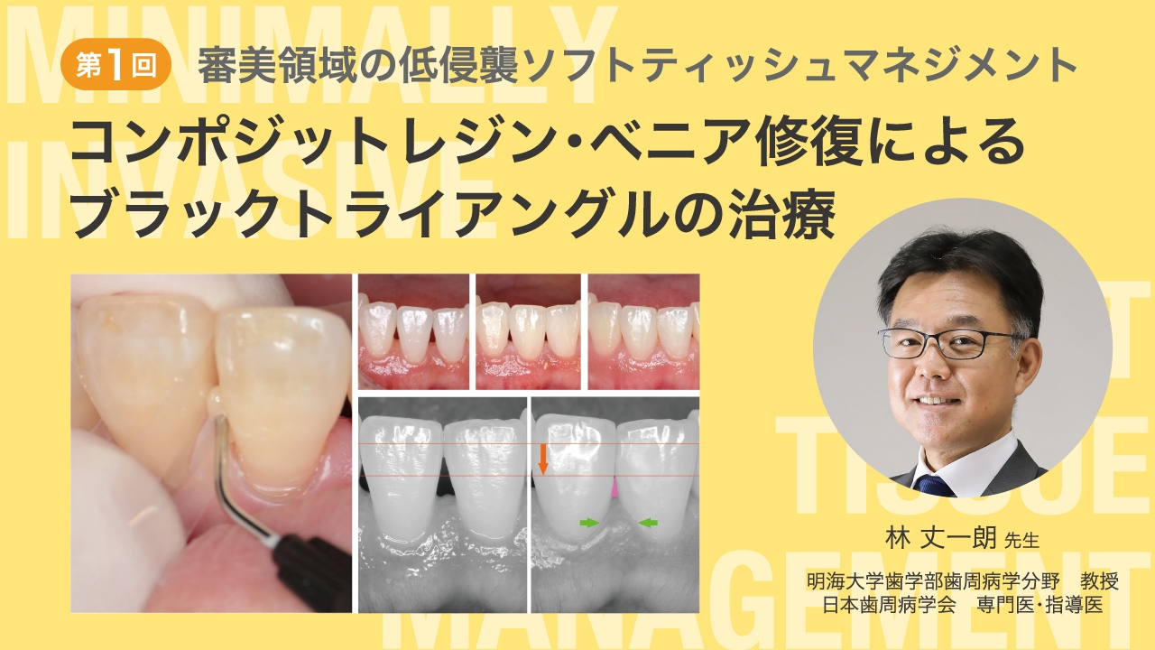 第1回 コンポジットレジン・ベニア修復によるブラックトライアングルの治療の画像です。