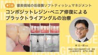 第1回 コンポジットレジン・ベニア修復によるブラックトライアングルの治療の画像です。