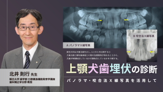 上顎犬歯埋伏の診断〜パノラマ・咬合法Ｘ線写真を活用して〜の画像です。